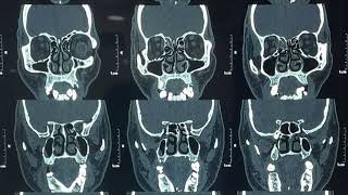 INFERIOR TURBINATE HYPERTROPHY [upl. by Drawde]