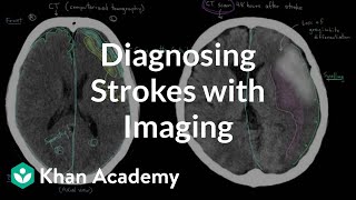 Diagnosing strokes with imaging CT MRI and Angiography  NCLEXRN  Khan Academy [upl. by Chic]