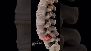 spondylolisthesis anatomy [upl. by Avik352]