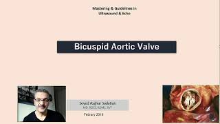 Bicuspid Aortic Valve [upl. by Frieder]