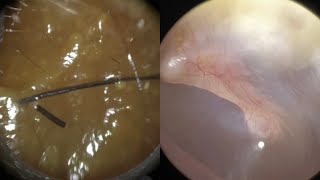 149  Type 2 Ear Wax Removal Based on Rai Modified ‘Bristol’ Cerumen Chart using WAXscope®️ [upl. by Clevey]