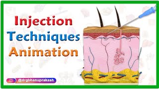 Injection Techniques Animation  Intradermal Intramuscular Subcutaneous and Z track [upl. by Ariaz841]