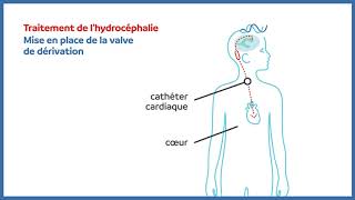 Hydrocéphalie  valve de dérivation cardiaque [upl. by Ocihc68]