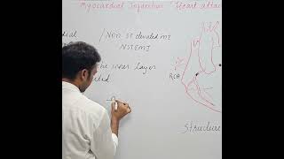 myocardial Infarction Heart attack NSTEMI  subendocardial Infarction [upl. by Harrus]