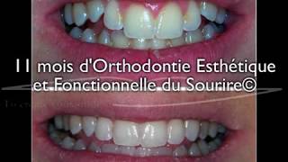 Sourire gingival sur adolescent  correction en 11 mois par aligneurs® en OEFS© [upl. by Iver817]