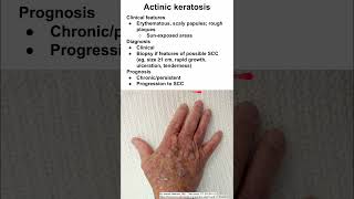 Actinic keratosis [upl. by Ilecara]