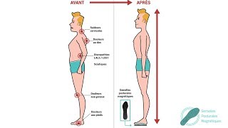 Test des semelles posturales magnétiques [upl. by Werdnaed]