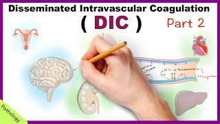 DIC Disseminated Intravascular Coagulation  Part 2 [upl. by Teressa]