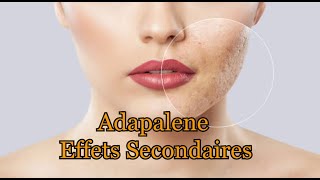 Adapalene Effets secondaires [upl. by Carin824]