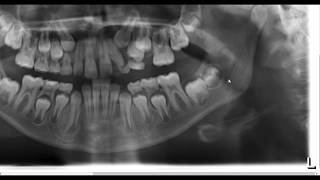 4th molar or pathology or normal anatomy [upl. by Hadihahs172]