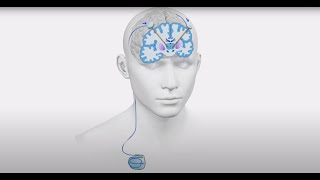 Deep Brain Stimulation DBS for Parkinson’s Disease Essential Tremor and Epilepsy [upl. by Llednohs]