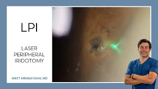 LPI Laser Peripheral Iridotomy [upl. by Gent]