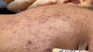 ACNE TREATMENT BO NGUYỄN  Blackheads amp Whiteheads Removal 2024 [upl. by Akimert]