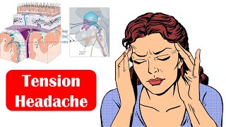 Tension Headache  Causes Signs amp Symptoms And Treatment [upl. by Hylton418]