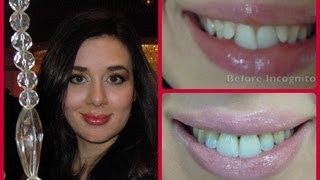 • Incognito Lingual Braces Treatment Halfway Update Before and After • [upl. by Natloz]