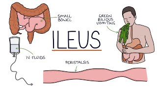 Understanding Ileus Paralytic Ileus [upl. by Anauqahs]