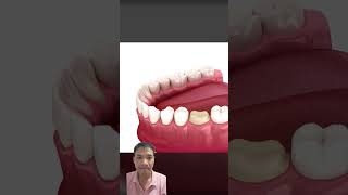 Gentle Dental Care ASMR Cavity Removal and Crown Replacement asmr dentition shorts [upl. by Lehctim]