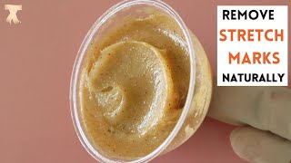 How to make a stretch marks removal cream at home [upl. by Doscher549]