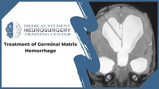 Treatment of Germinal Matrix Hemorrhage [upl. by Aislehc758]