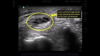 Tibialis Posterior tendon tear [upl. by Audley]