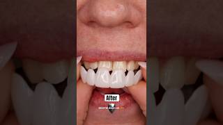 Snap On Veneers Instant Smile Makeover [upl. by Prince167]