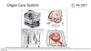 TRASPLANTE CARDIACO CON DONADOR EN ASISTOLIA [upl. by Aicats]