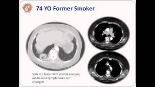 Mediastinal Staging Webinar [upl. by Yenal24]