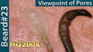 23 Pull Out BeardViewpoint of Pores Blackhead and Hair RootRoot Sheath Close up [upl. by Nixie970]