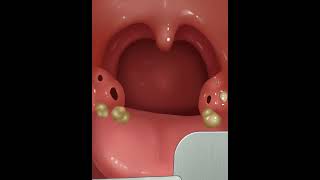 Treatment of oral gingivitis asmr shorts [upl. by Albarran]