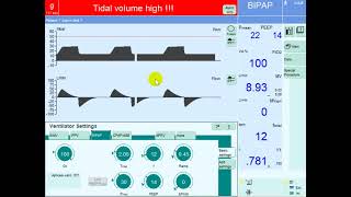 Optimizing Oxygenation on Mechanical Ventilation Strategies for Improving MAP in Hypoxemic Patients [upl. by Aika]