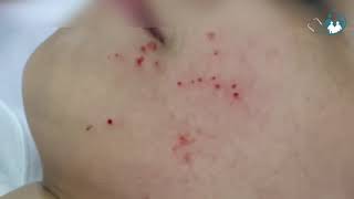 Molusco Contagioso  Ep 01 curetagem em paciente de 11 anos [upl. by Donnamarie]