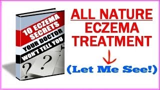 Eczema Treatment  How To Get Rid Of Eczema Naturally [upl. by Tengler]