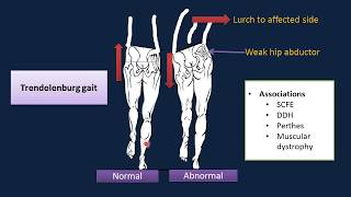 The limping Child and a high yield facts [upl. by Narmak]