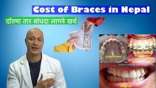 Cost of Braces and Aligners in Nepal  Dr Bikash Vlog [upl. by Eugenle]