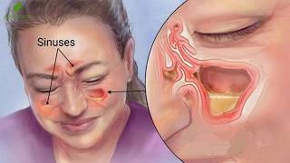 Conoce Como Puedes Eliminar Todo El Moco Y La Flema De Tu Garganta Y Pulmones [upl. by Cristiona]