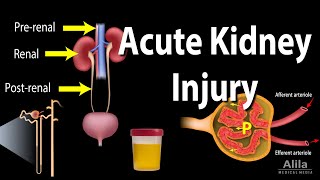 Acute Kidney Injury aka Acute Renal Failure Animation [upl. by Atnuahc]