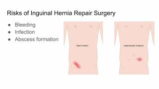 Inguinal Hernia Repair Surgery Risks and Outcomes  CHI Health [upl. by Horatio898]