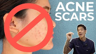 How to get rid of Acne Scars  Dr Davin Lim [upl. by Kolosick490]