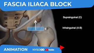 Scanning principles for Infrainguinal vs Suprainguinal Fascia Iliaca block  NYSORAs Animations [upl. by Ahseina679]