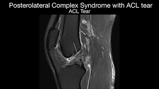 Posterolateral Corner Syndrome with ACL Tear [upl. by Ahseenal510]