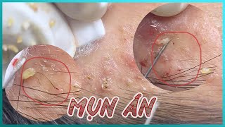 Big Cystic Acne Blackheads Extraction Blackheads amp Milia Whiteheads Removal Pimple Popping [upl. by Philippa]