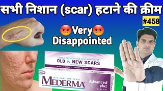 Mederma cream  mederma for acne scars  mederma advanced scar gel review [upl. by Binette]