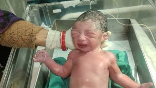 Caput succedaneum is swelling edema that affects a newborns scalp baby beautiful viral new [upl. by Nadean303]