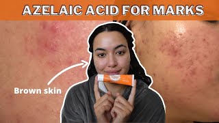 HOW TO FADE POST INFLAMMATORY HYPERPIGMENTATIONERYTHEMA WITH AZELAIC ACID SKINOREN 20 cream [upl. by Carmelina899]