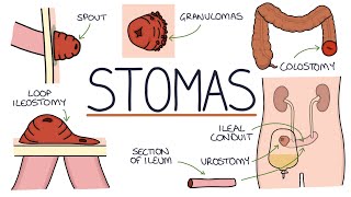 Understanding Stomas Colostomy Ileostomy Urostomy and Gastrostomy [upl. by Beale]