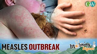 MEASLES OUTBREAK INDIA RANKS 2ND AMONG 57 NATIONS HIT [upl. by Conrade815]