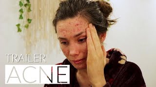 Normalising Acne Documentary  Trailer [upl. by Nesmat]