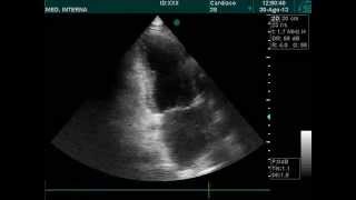 Apical hypokinesis echocardiography doppler ultrasound [upl. by Derf371]