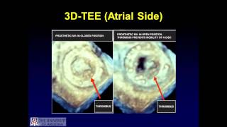 Prosthetic Mitral Valve Obstruction Accurate Diagnosis by 3D Transesophageal Echocardiography [upl. by Demetris]