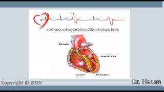 Extrasystole  Premature contraction  atrial nodal and ventricular extrasystole [upl. by Ledua553]